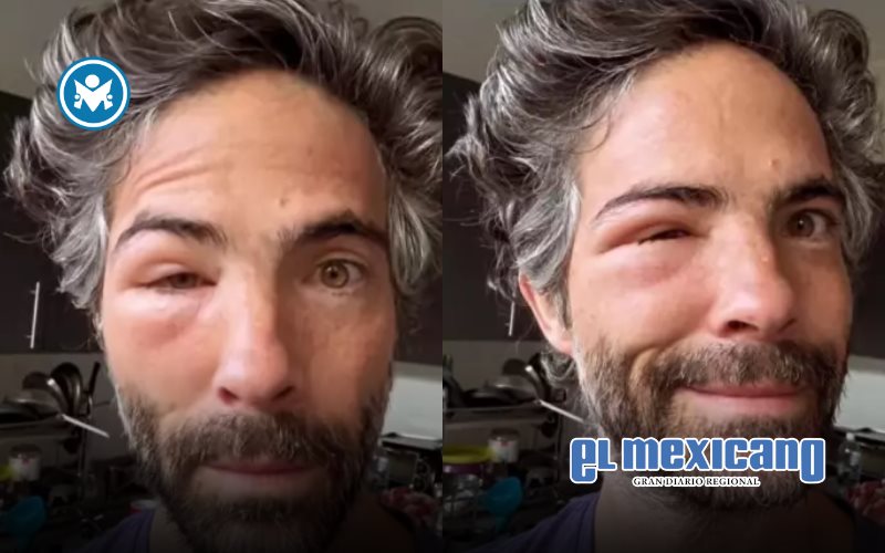 ¿Qué le pasó?: Osvaldo Benavides aparece con el rostro desfigurado ¿Qué le pasó?: Osvaldo Benavides aparece con el rostro desfigurado