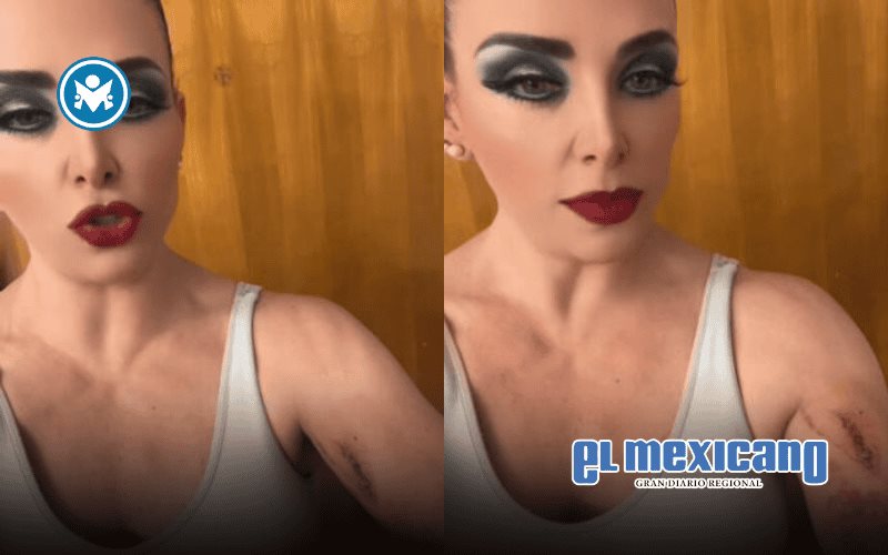 Mi bícep me salvó la vida: Lisset sufre accidente en coladera de CDMX Mi bícep me salvó la vida: Lisset sufre accidente en coladera de CDMX