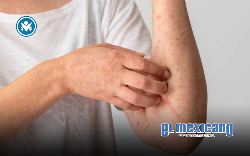 México enfrenta brote de sarampión; 583 casos confirmados y un fallecimiento México enfrenta brote de sarampión; 583 casos confirmados y un fallecimiento