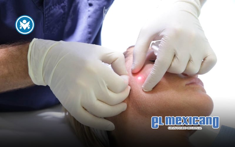 Así es Endolift, el láser sin cirugía que estimula la producción de colágeno en la piel Así es Endolift, el láser sin cirugía que estimula la producción de colágeno en la piel