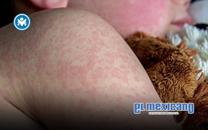 Muere bebé rarámuri por sarampión en Chihuahua; suman cinco fallecidos en el país
