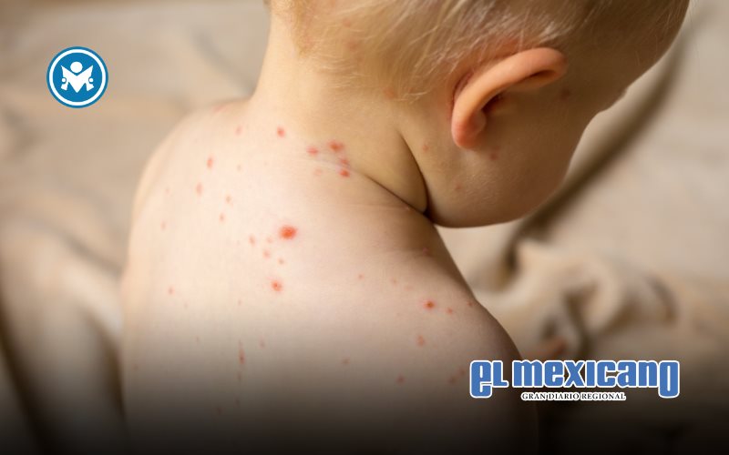 Brote de sarampión en Chihuahua supera los 2200 casos y registra 8 muertes Brote de sarampión en Chihuahua supera los 2200 casos y registra 8 muertes
