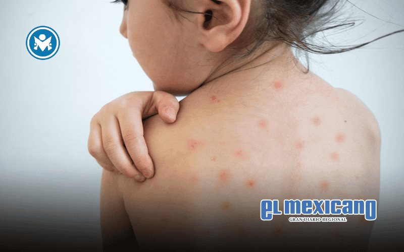 México supera los 2900 casos confirmados de sarampión y suma nueve muertes México supera los 2900 casos confirmados de sarampión y suma nueve muertes
