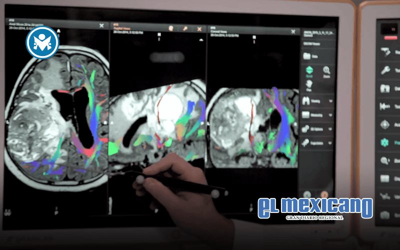 Precisión contra el cáncer cerebral: la nueva era de la neurotecnología Precisión contra el cáncer cerebral: la nueva era de la neurotecnología
