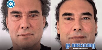 Eduardo Yáñez sorprende con rejuvenecimiento facial sin cirugía