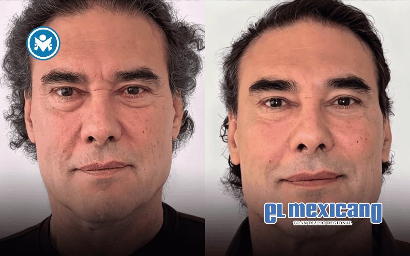 Eduardo Yáñez sorprende con rejuvenecimiento facial sin cirugía Eduardo Yáñez sorprende con rejuvenecimiento facial sin cirugía