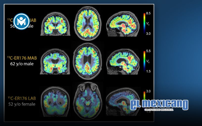 Nuevos trazadores de inflamación son pieza clave en el desarrollo de la enfermedad de Alzheimer