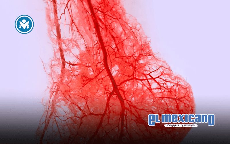 Reducción de amputaciones mediante técnicas avanzadas de revascularización Reducción de amputaciones mediante técnicas avanzadas de revascularización