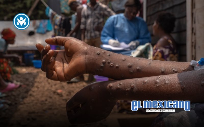 OMS levanta la emergencia sanitaria internacional por mpox tras descenso de casos OMS levanta la emergencia sanitaria internacional por mpox tras descenso de casos