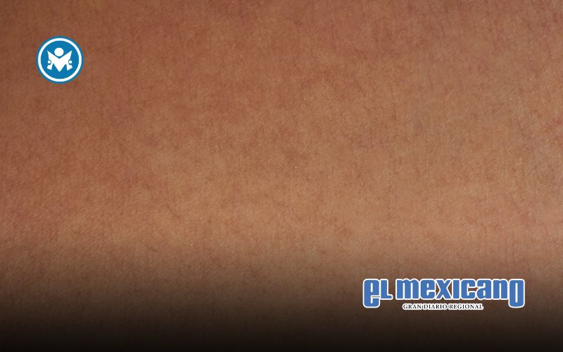 AbbVie impulsa el conocimiento y la visibilidad de la Dermatitis Atópica