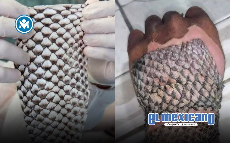 Piel de tilapia, la innovadora cura que acelera la recuperación de quemaduras