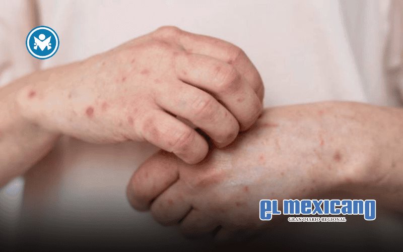 Brote de sarampión se expande a 25 estados de México con más de 4.800 casos