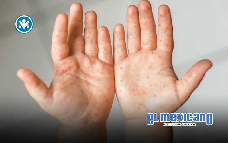 Suspenden clases este viernes en Tecate, Tijuana, Playas de Rosarito, Ensenada y San Quintín por brote leve de virus Coxsackie