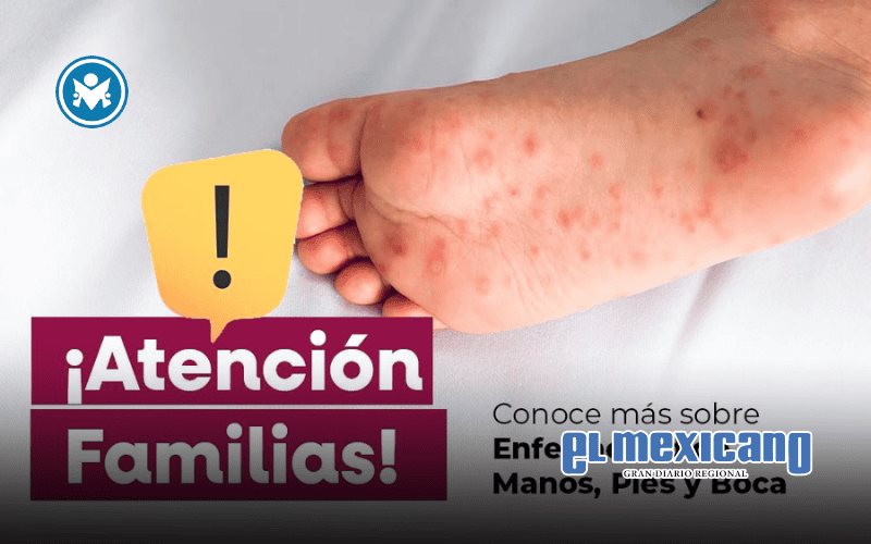 Ensenada refuerza medidas preventivas ante virus Coxsackie Ensenada refuerza medidas preventivas ante virus Coxsackie