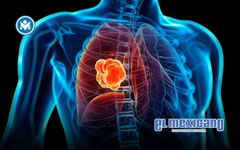 FDA otorga aprobación acelerada para terapia oral dirigida para cáncer de pulmón avanzado FDA otorga aprobación acelerada para terapia oral dirigida para cáncer de pulmón avanzado