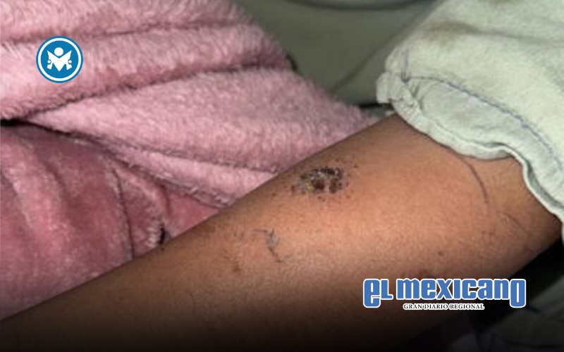 Confunden picadura de araña con la de un mosquito en la Primaria Centenario de la Revolución Confunden picadura de araña con la de un mosquito en la Primaria Centenario de la Revolución