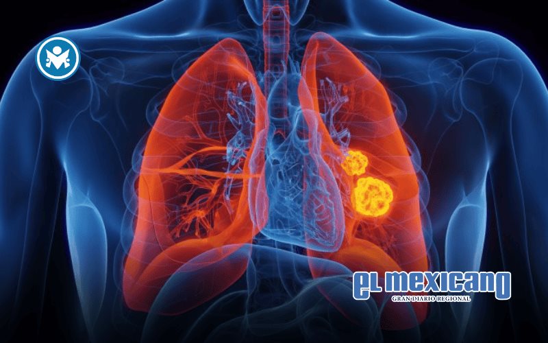 C&aacute;ncer de pulm&oacute;n: la enfermedad prevenible que sigue siendo la principal causa de muerte por tumores