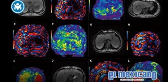 Innovación en resonancia magnética de secuencia corta para diagnosticar hígado graso con fibrosis Innovación en resonancia magnética de secuencia corta para diagnosticar hígado graso con fibrosis