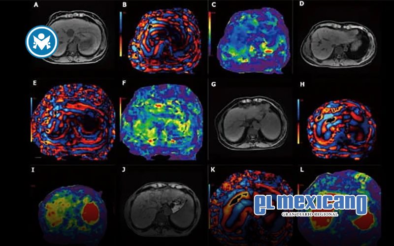 Innovación en resonancia magnética de secuencia corta para diagnosticar hígado graso con fibrosis