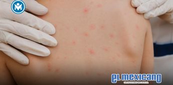 México confirma primer caso importado de sarampión en 2025 y refuerza vigilancia en Mexicali México confirma primer caso importado de sarampión en 2025 y refuerza vigilancia en Mexicali