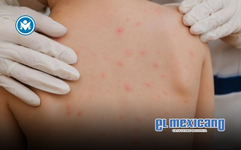 México confirma primer caso importado de sarampión en 2025 y refuerza vigilancia en Mexicali
