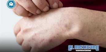 Suben a ocho los casos de sarampi&oacute;n en BC