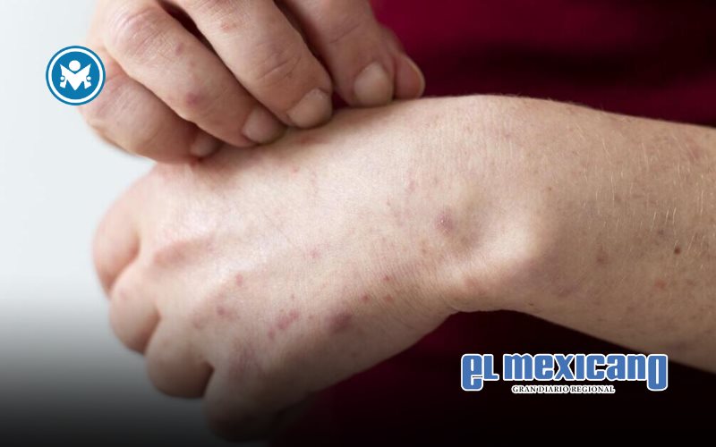 Suben a ocho los casos de sarampi&oacute;n en BC