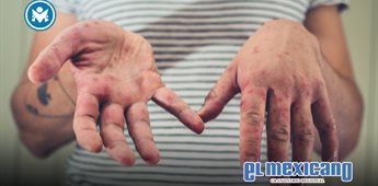 Secretar&iacute;a de Salud intensifica medidas ante brote de sarampi&oacute;n en M&eacute;xico