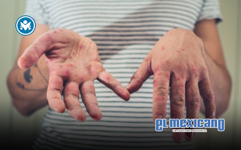 Secretar&iacute;a de Salud intensifica medidas ante brote de sarampi&oacute;n en M&eacute;xico