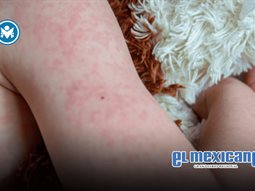 Muere bebé de un año por sarampión en Tlaxcala Muere bebé de un año por sarampión en Tlaxcala