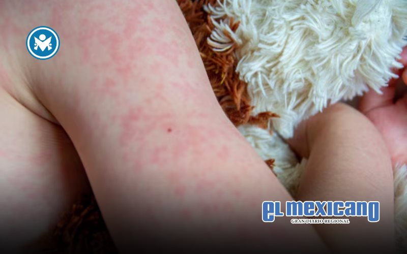 Muere bebé de un año por sarampión en Tlaxcala