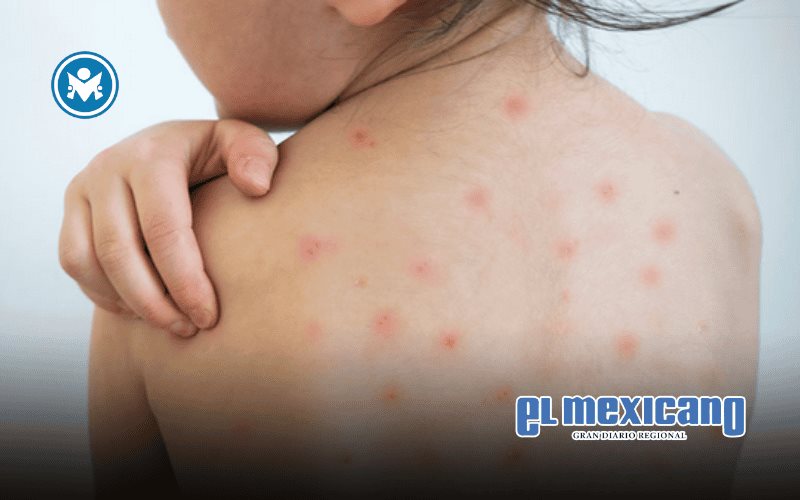 SEP suspende clases presenciales en Jalisco y Aguascalientes por brote de sarampión SEP suspende clases presenciales en Jalisco y Aguascalientes por brote de sarampión