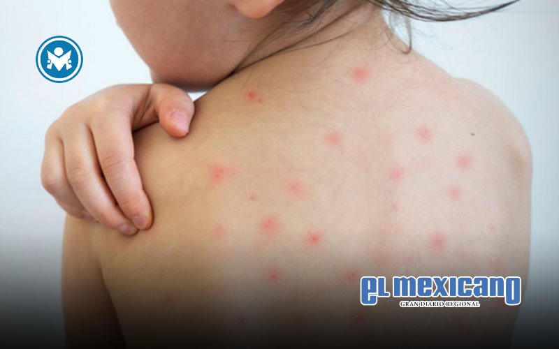 SEP suspende clases presenciales en Jalisco y Aguascalientes por brote de sarampión SEP suspende clases presenciales en Jalisco y Aguascalientes por brote de sarampión