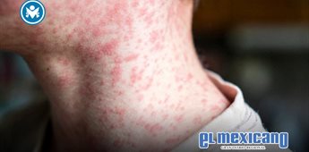 OPS lanza alerta epidemiol&oacute;gica por brote de sarampi&oacute;n en las Am&eacute;ricas