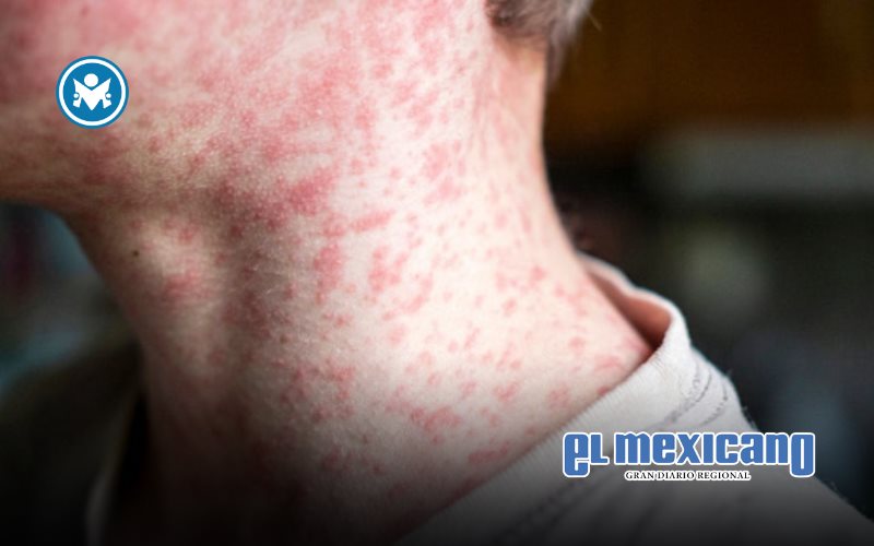 OPS lanza alerta epidemiol&oacute;gica por brote de sarampi&oacute;n en las Am&eacute;ricas