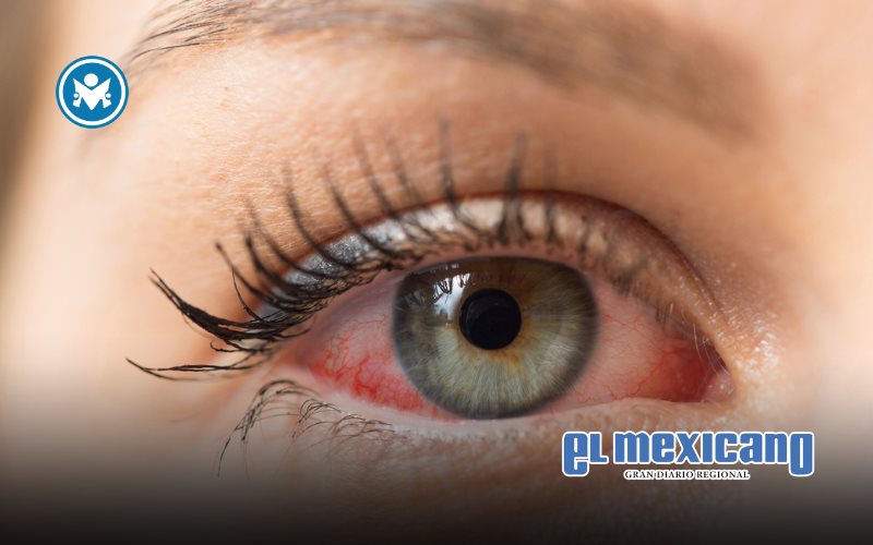 Ojo seco: una condici&oacute;n silenciosa que afecta hasta al 75% en ciudades; lanzan campa&ntilde;a nacional de concientizaci&oacute;n