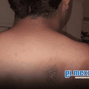 Estudiante de secundaria en la colonia Libertad sufre quemaduras tras ataque con sosa cáustica Estudiante de secundaria en la colonia Libertad sufre quemaduras tras ataque con sosa cáustica