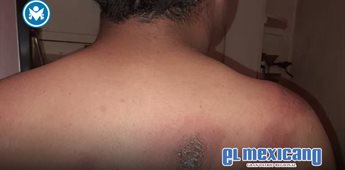 Estudiante de secundaria en la colonia Libertad sufre quemaduras tras ataque con sosa cáustica Estudiante de secundaria en la colonia Libertad sufre quemaduras tras ataque con sosa cáustica