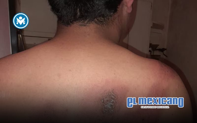 Estudiante de secundaria en la colonia Libertad sufre quemaduras tras ataque con sosa c&aacute;ustica