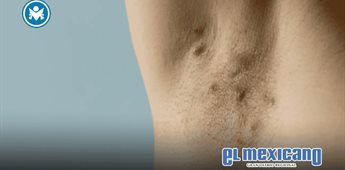 Hidradenitis supurativa: la enfermedad de la piel que puede tardar hasta ocho a&ntilde;os en diagnosticarse