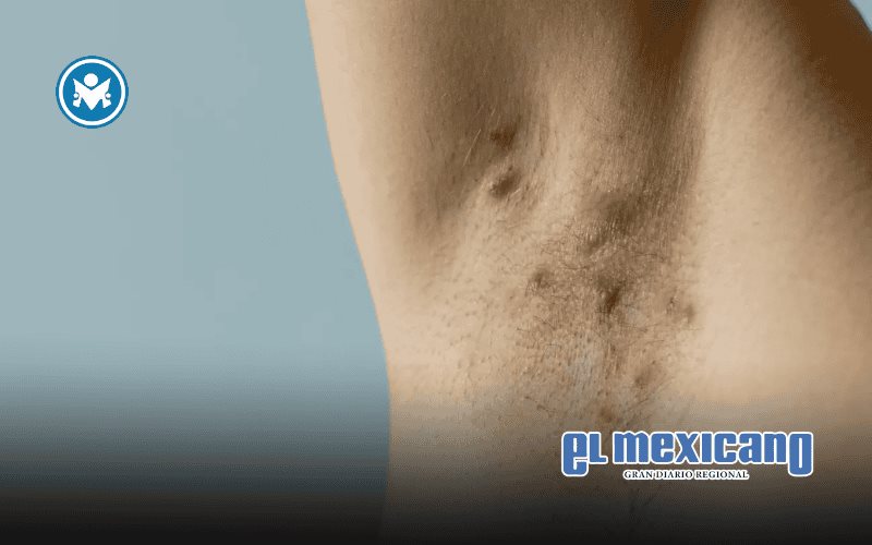 Hidradenitis supurativa: la enfermedad de la piel que puede tardar hasta ocho a&ntilde;os en diagnosticarse
